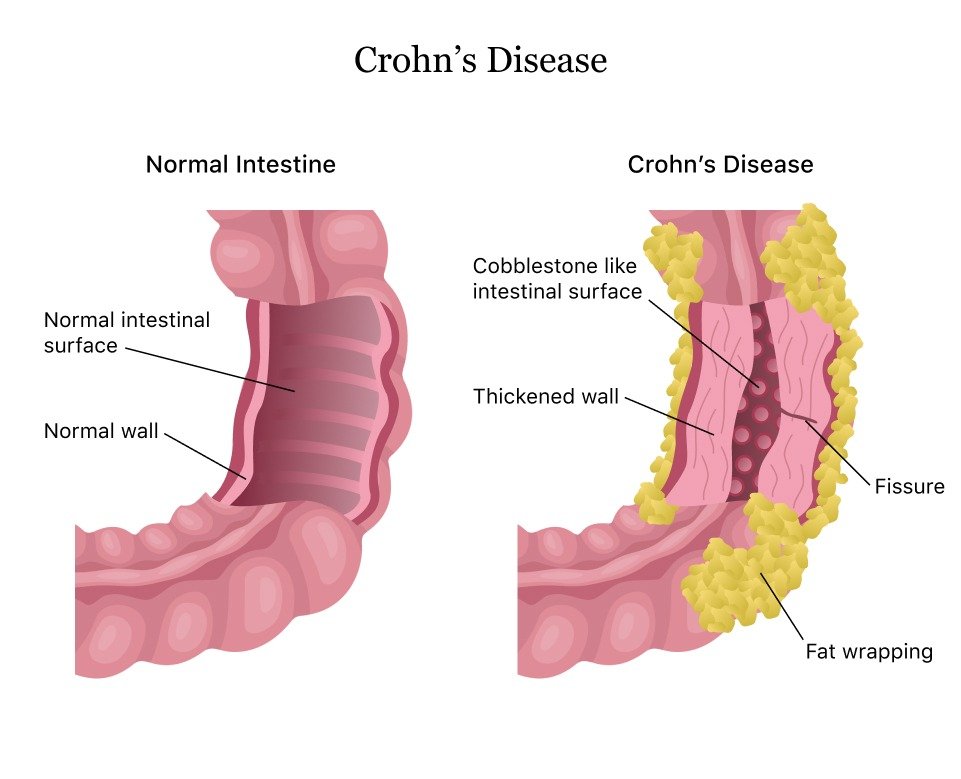 Crohn's Disease