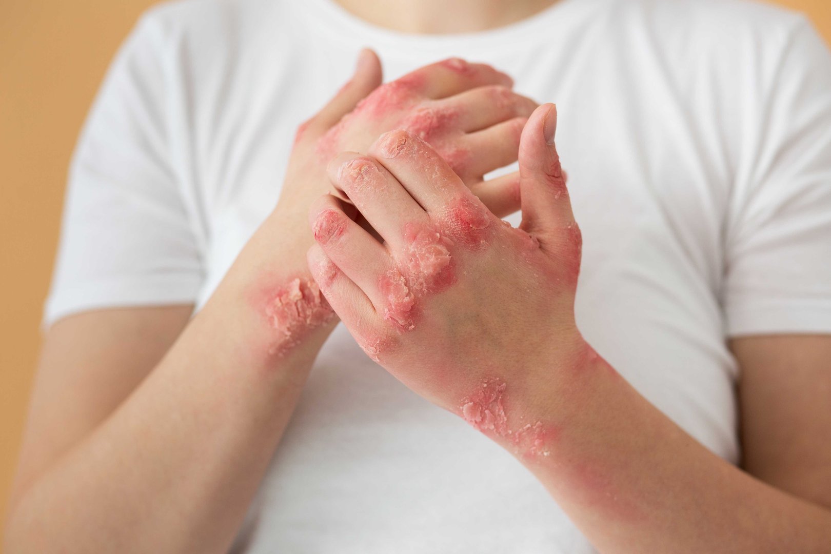 Eczema Treatment
