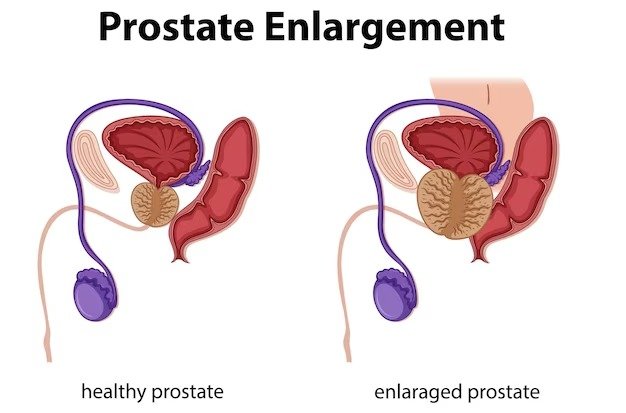 Erectile dysfunction after Heart Bypass Surgery ClinicSpots