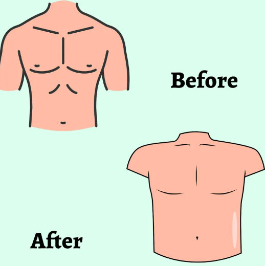 No Nip Top Surgery