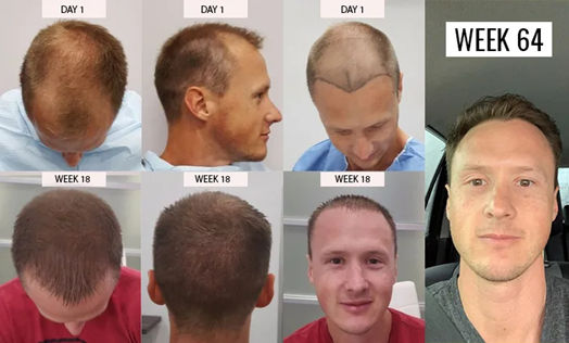 hair transplant in mexico before/after