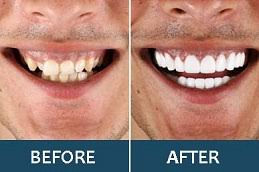 before after hollywood smile dubai