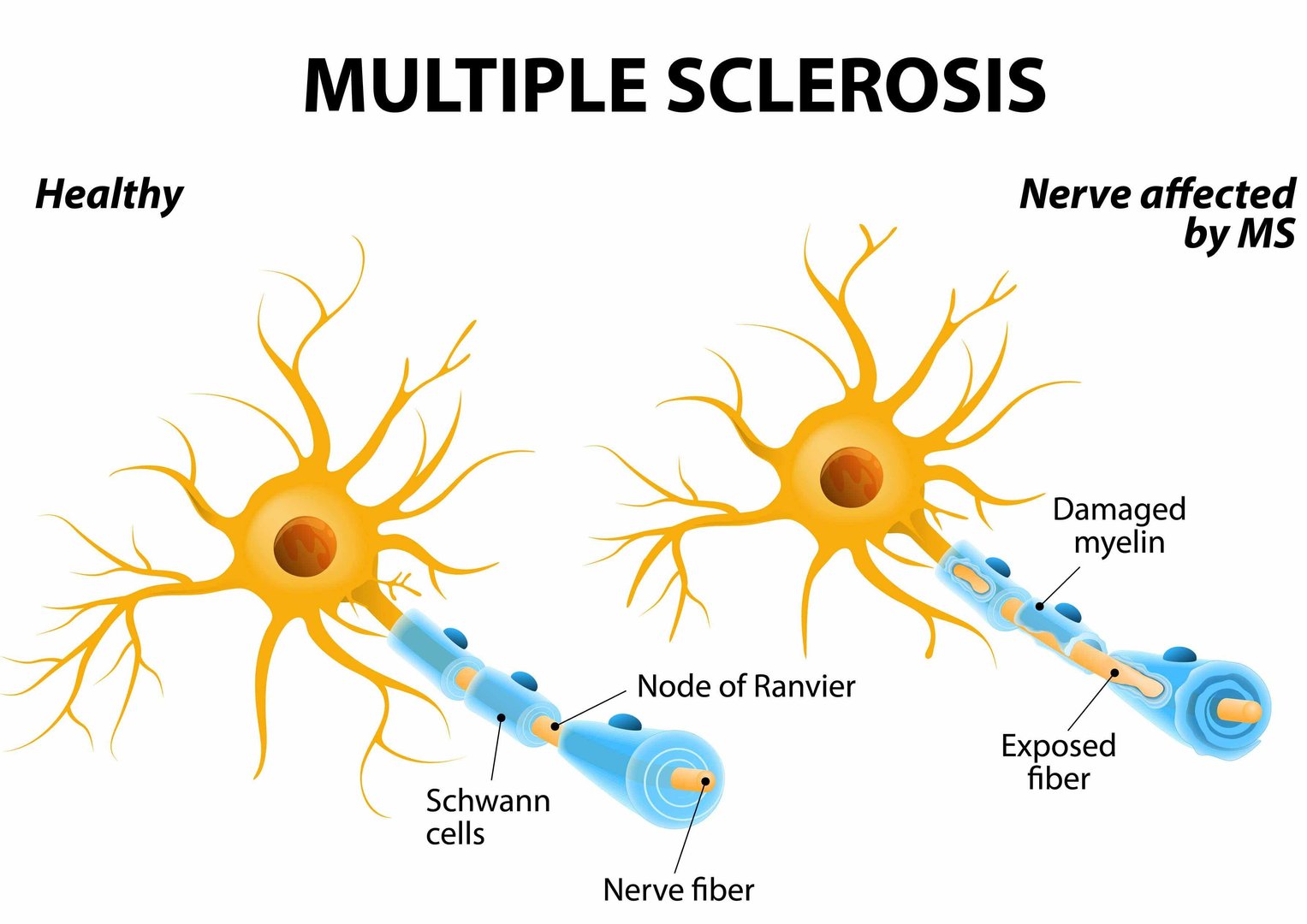 Multiple Sclerosis