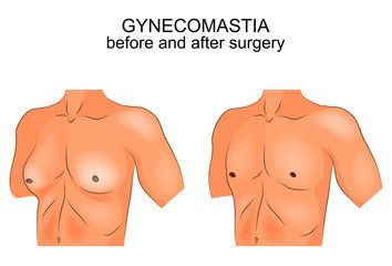 gynecomastia surgery before/after