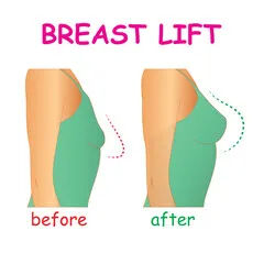breast lift in dubai before/after