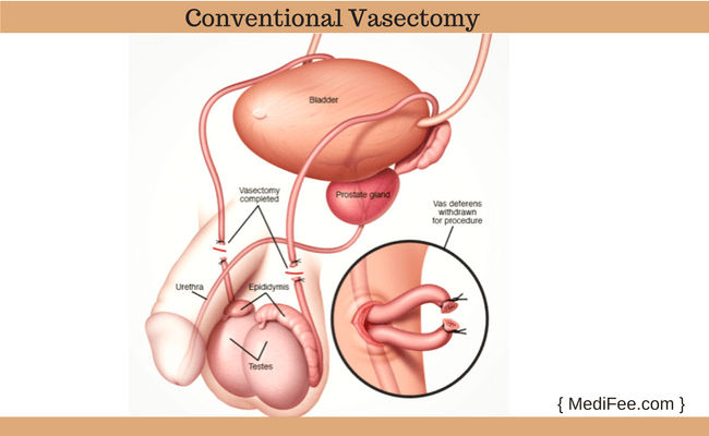 Conventional Vasectomy