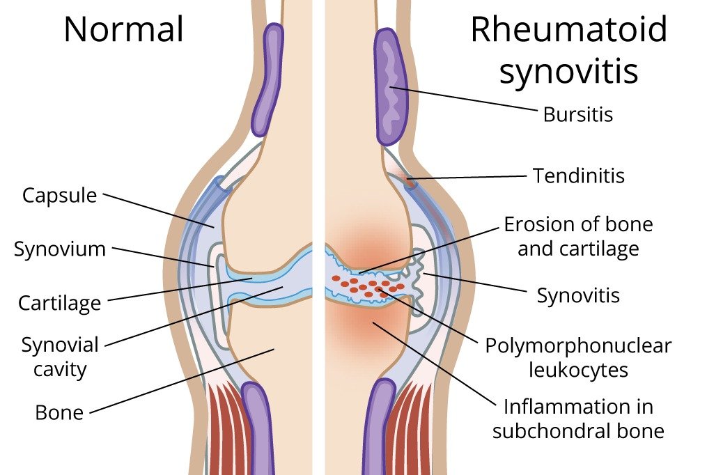 Rheumatoid arthritis