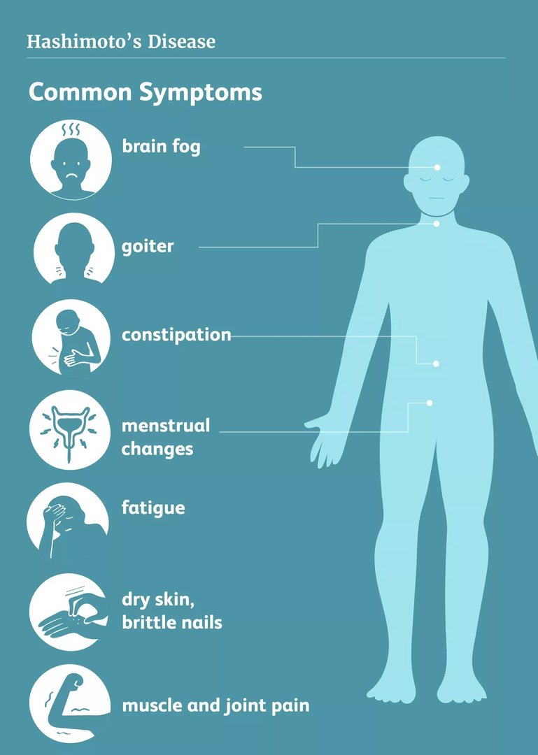 Symptoms of Hashimoto's disease