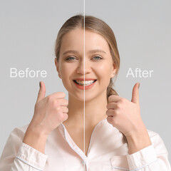 Hollywood smile before/after