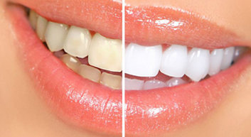 All That You Must Know About Cosmetic Dental Treatment In India