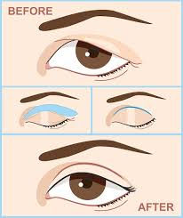 double eyelid surgery