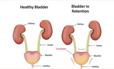 Causes urinary retention after catheter removal