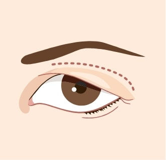 upper eyelid surgery
