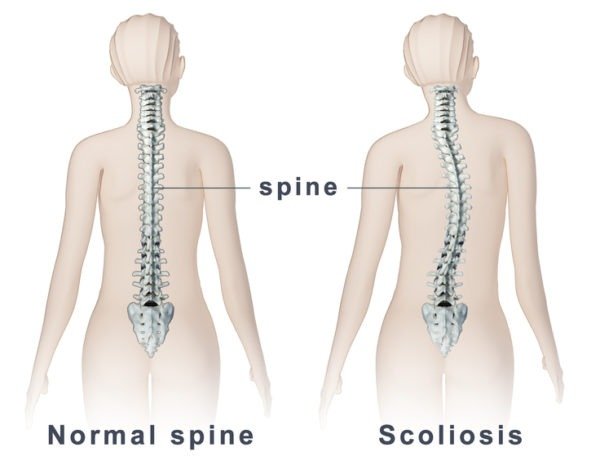 scoliosis