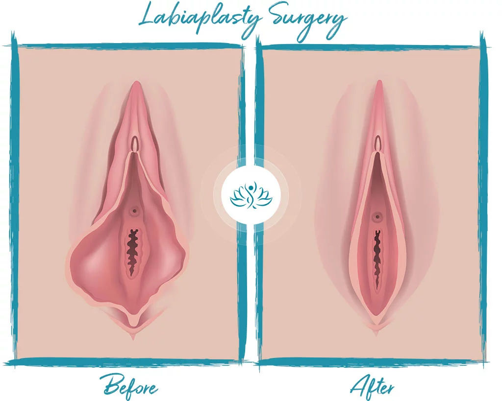 labiaplasty dubai before/after
