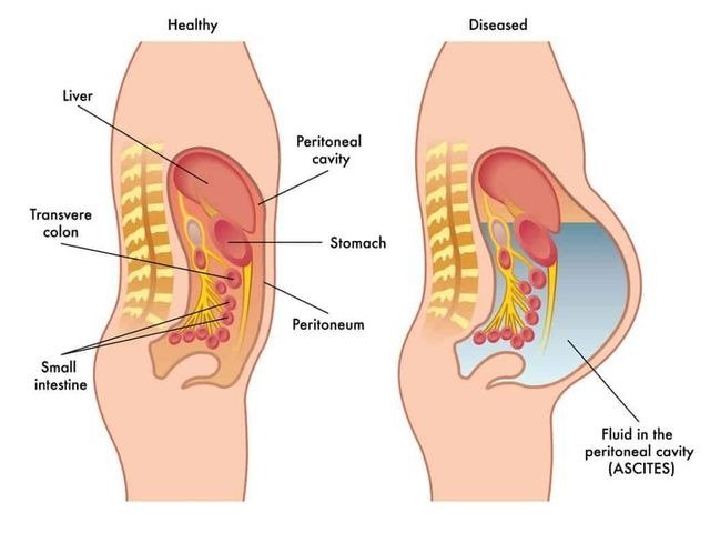 Ascites in Renal Failure