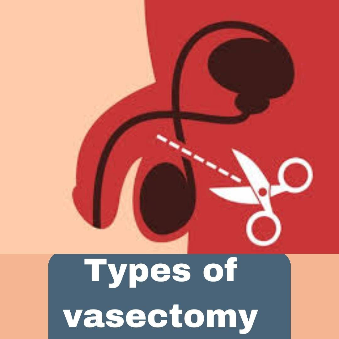 types of vasectomy