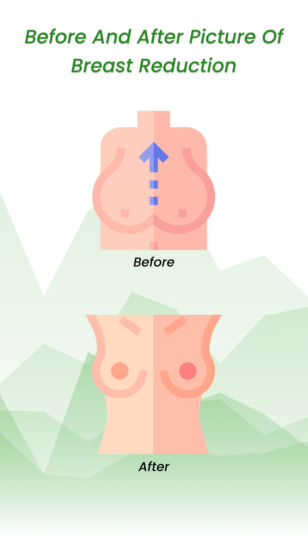 Before/After breast reduction Turkey