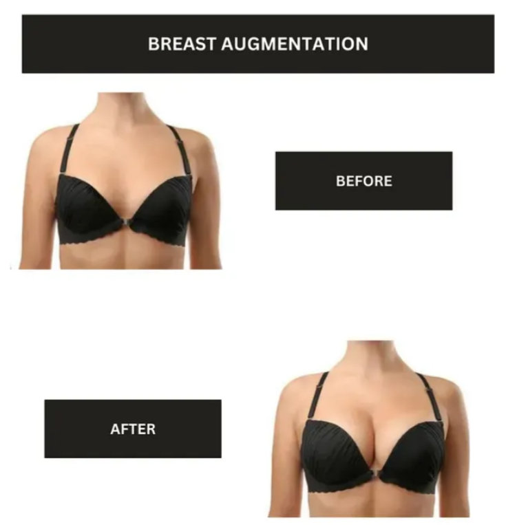 Boob Job Before/After Results