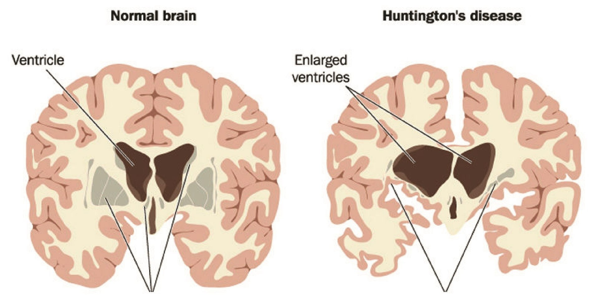 Huntington's disease