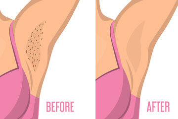 laser hair removal before/after