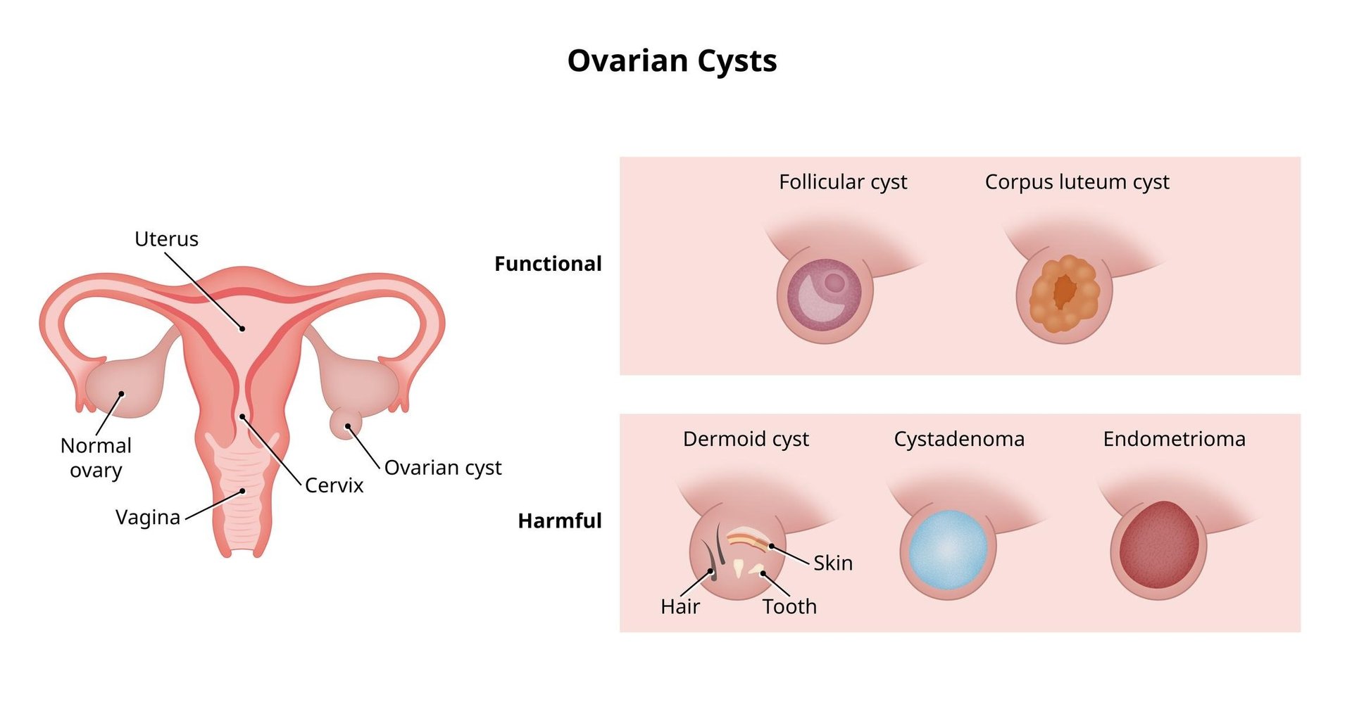 Types of Ovarian Cysts