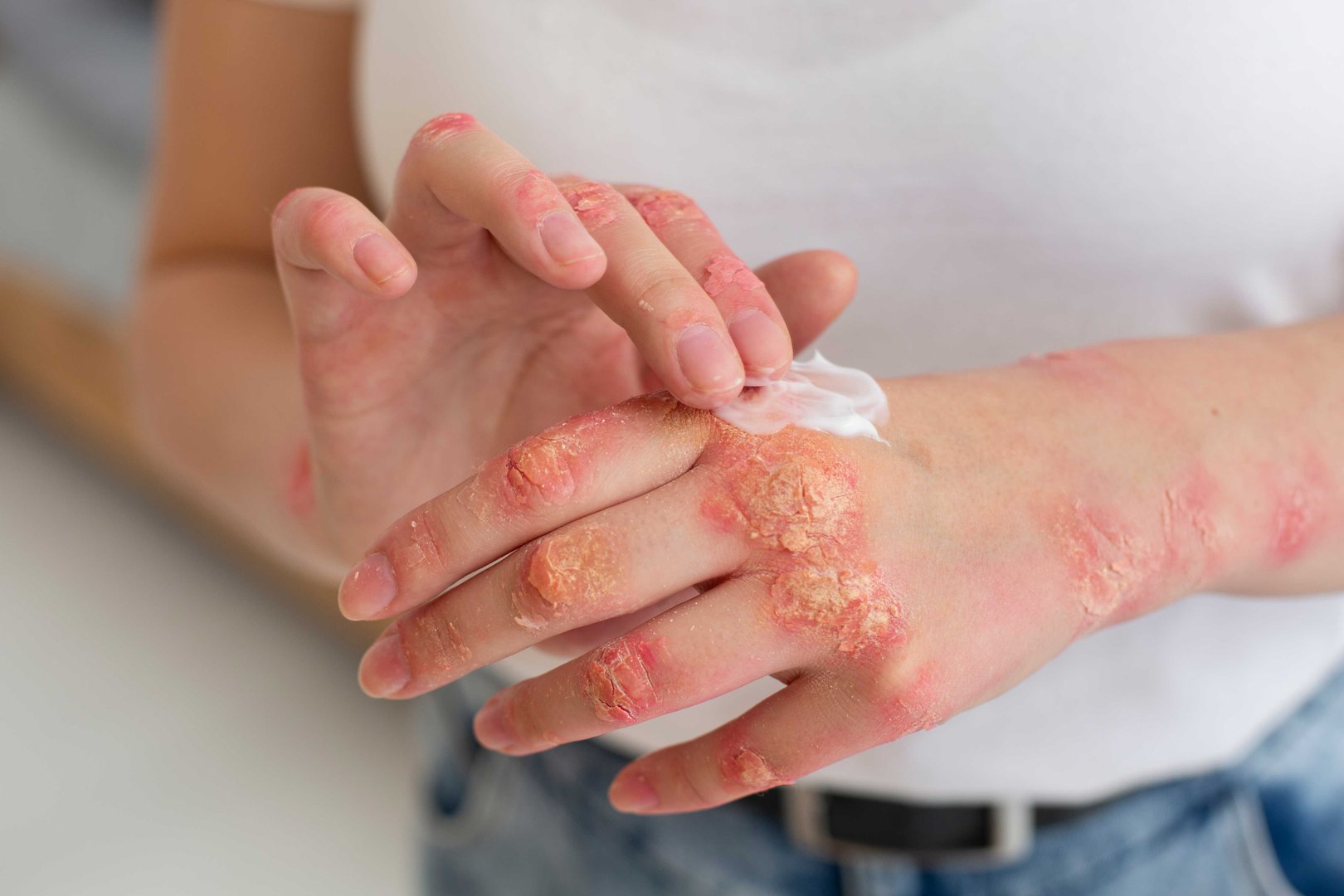 Stem Cell for Psoriasis