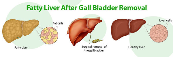 Fatty Liver after Gallbladder Removal: All You Need to Know