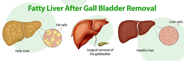 Fatty Liver After Gallbladder Removal All You Need To Know ClinicSpots