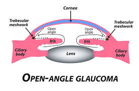What Is Primary Open Angle Glaucoma (POAG)?