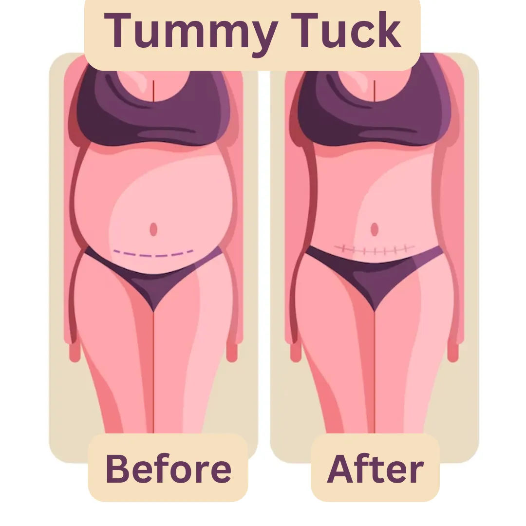 tummy tuck before/after