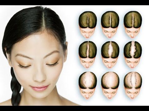 Hair Transplant – The Cost in India | Hair Sure