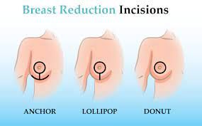 Types of breast reduction