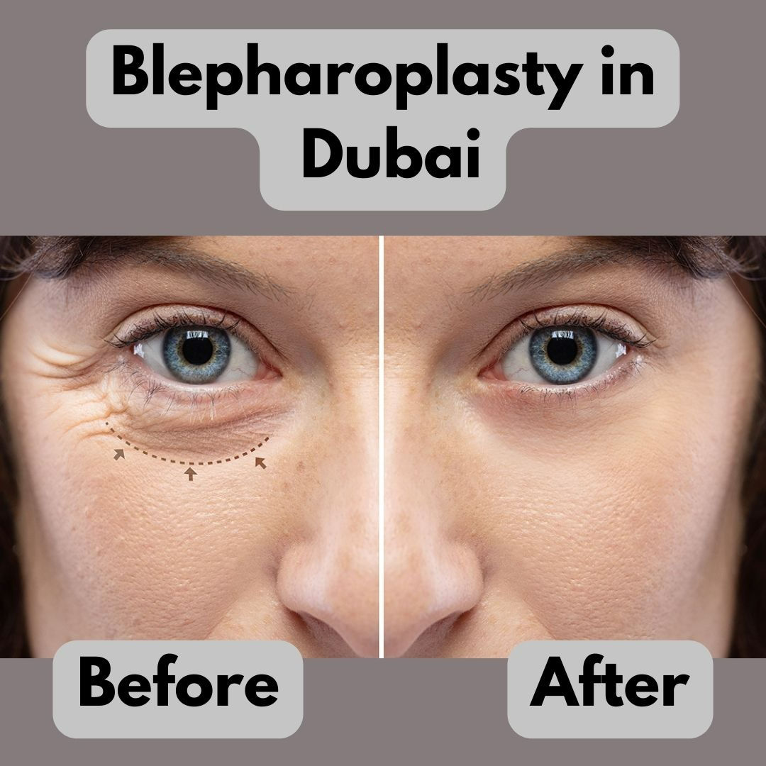blepharoplasty before/after results in dubai
