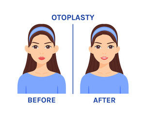 Otoplasty before/after