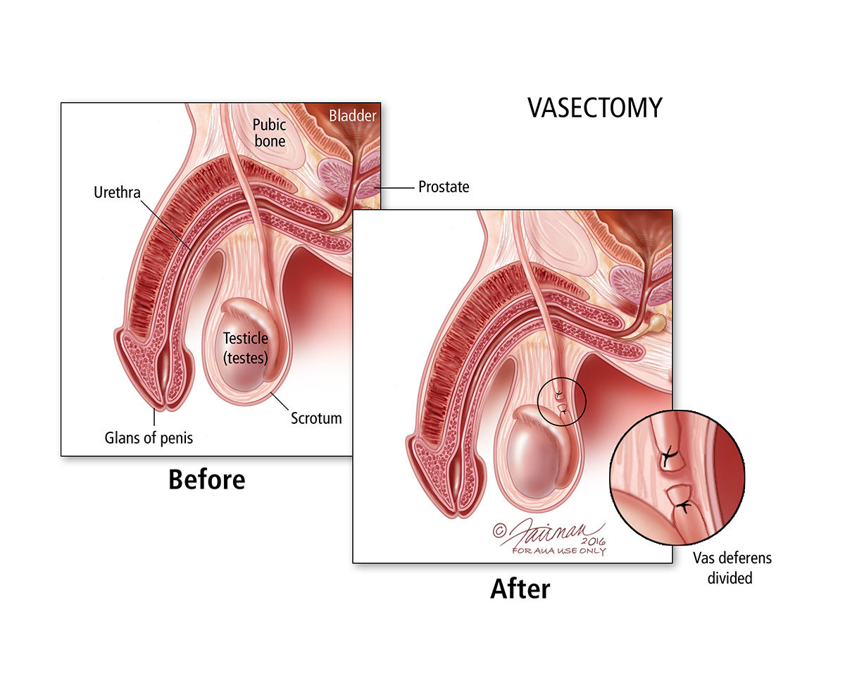 vasectomy before after