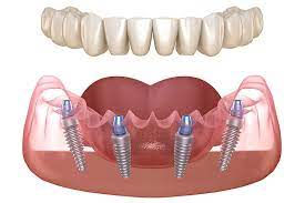 All-on-4 Implant: