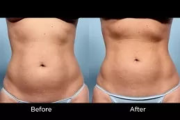 CoolSculpting Dubai before and after