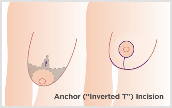 Anchor or Inverted-T Lift: