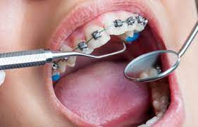 Orthodontic Procedures
