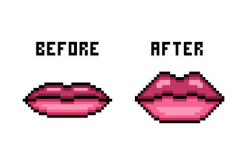 Lip fillers before/after