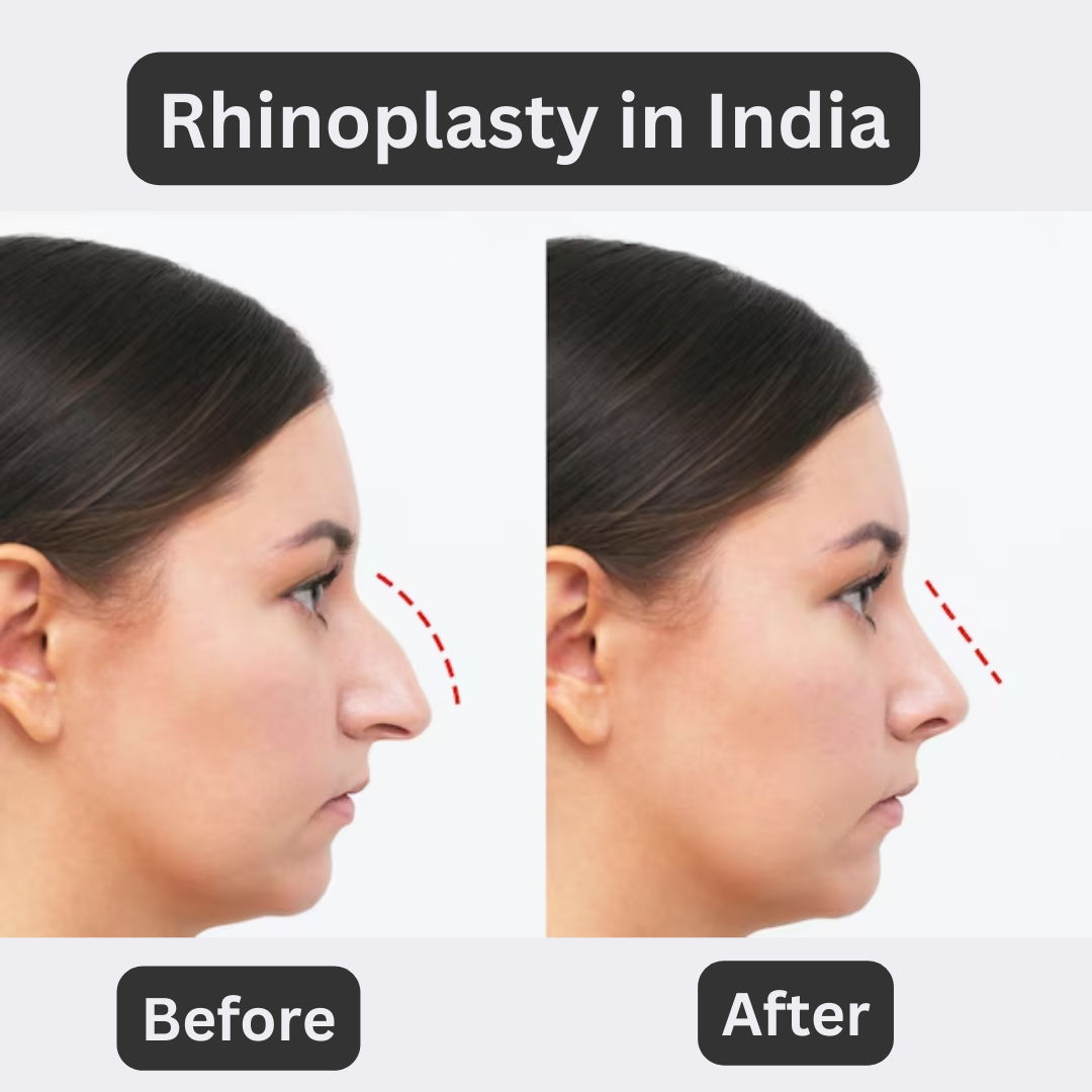 Rhinoplasty in India Before/After Results 