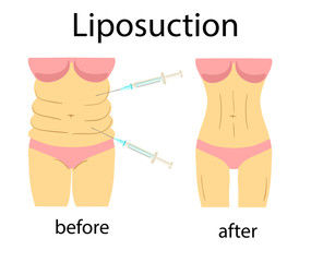 liposuction before after c section 