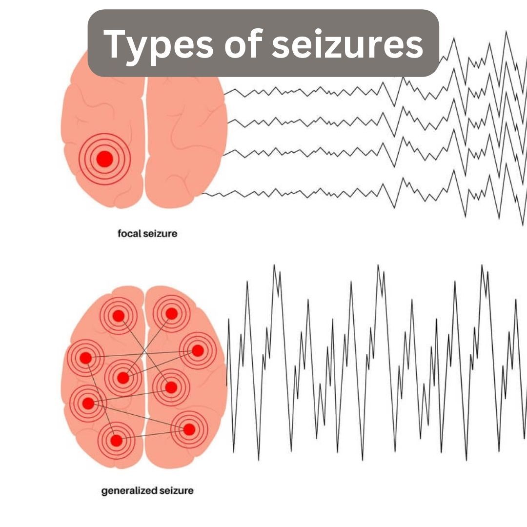  Types of seizures