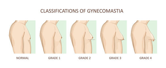 gynecomastia classification