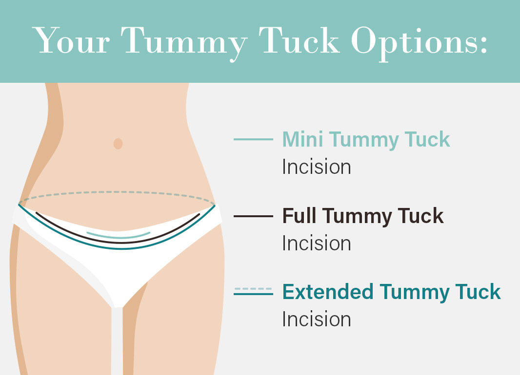 tummy tuck options in Dubai