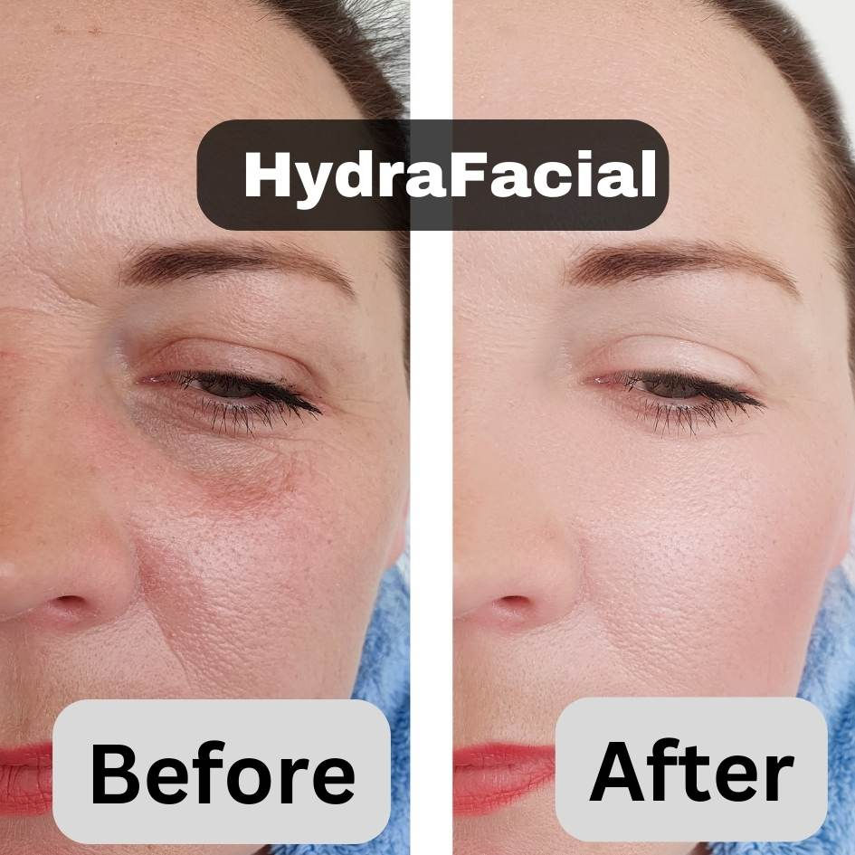 hydrafacial  in dubai before after