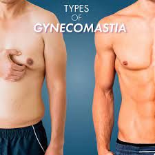 Types of Gynecomastia Surgeries