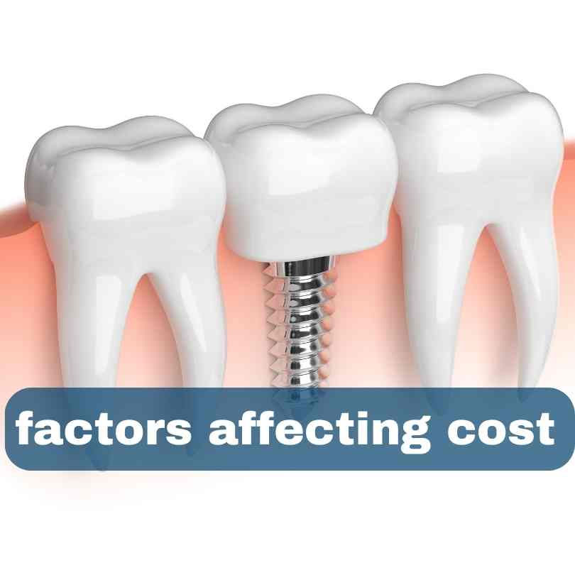 factors affecting dental implant cost