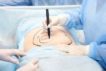 procedure of hysterectomy and tummy tuck